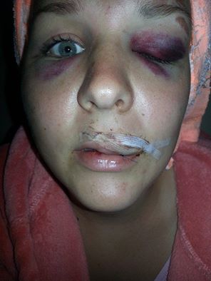 Egyetemista lány,pont olyan mint a tied,az enyém. Szombat este, a bátyja és a barátja társaságában célpontja lett 3, majd több,” irtó erős,bátor és igazán nemzeties lelkületű férfinek”. Ja csak ők hiszik magukat annak,szerintem primitív, az életükben nulla hatalommal rendelkező , kötekedő idióta barmok. Férfinak semmiképp nem nevezném őket,azok védik a nőket és nem agyonverik. Nem is tudom,hogy történhetett,de valahogy elbírtak egy alig ötven kilós lánnyal.Szája összevarrva,,arccsontját szilánkosra törték,reggel műtik. Gratulálok nekik,meglesznek ebben nem kételkedem és abban sem,hogy az élet nem marad adósa senkinek. Voltak ott többen is,talán van akinek a becsülete többet ér és nem hunyászkodik csendben. Kérem aki segíteni szeretne, tegye. Azt üzenem az elkövetőknek,hogy az igazi ERŐ nem az öklötökben rejlik,hanem a lélekben.Tanuljatok ettől a kicsi lánytól,akinek VAN lelki ereje ahhoz,hogy megmutassa így az arcát,önmagát.Nektek nincs. Fotó: Facebook / Sajóné Mákos Edit